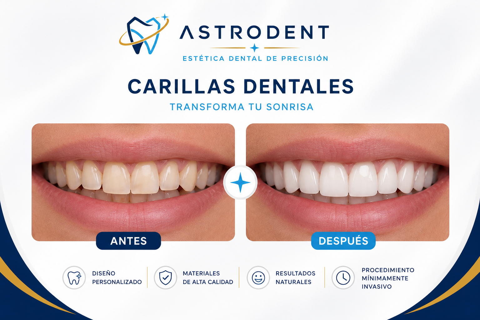 Carillas dentales de porcelana antes y después — clínica dental Bogotá ASTRODENT